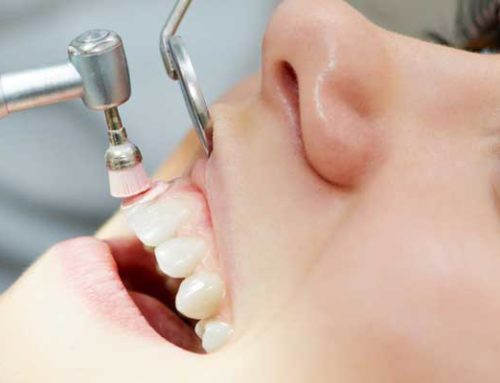 Entenda como é feita a Profilaxia: a limpeza dentária profissional