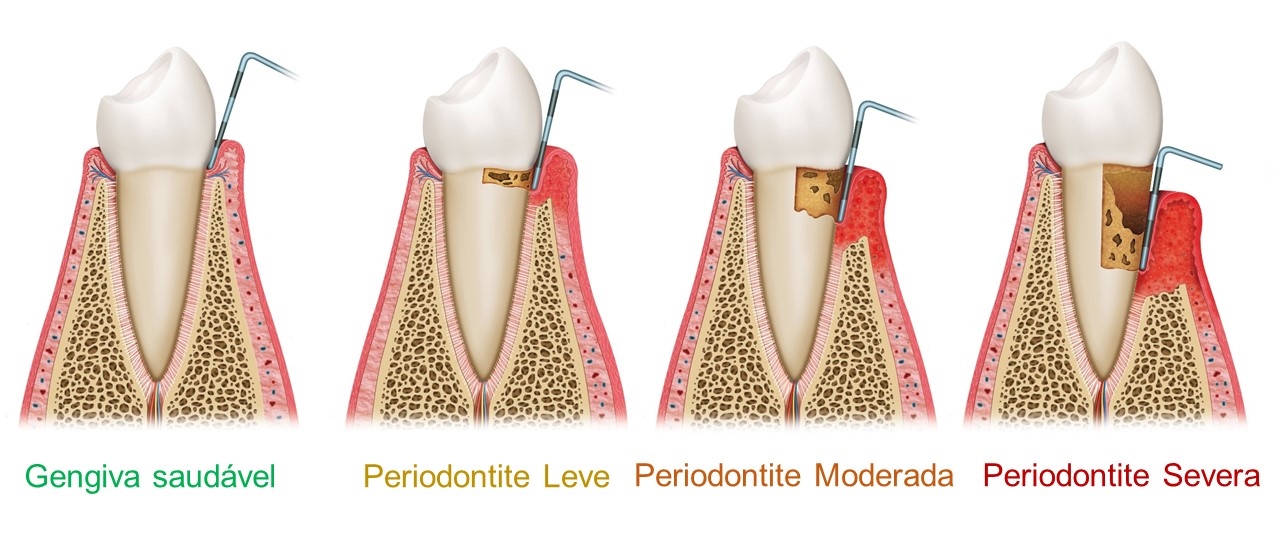 Progressão da doença periodontal.